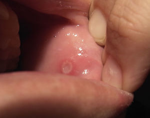 Afta oral. Afta en la mucosa oral de la paciente del caso A.