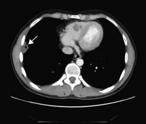 TAC torácica. La flecha señala una lesión parenquimatosa en el lóbulo inferior del pulmón derecho adyacente a la cisura menor con una pequeña cavitación. Caso B.