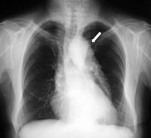 Radiografía postero-anterior de tórax donde se visualiza una dilatación de la aorta torácica. Fuente: elaboración propia.