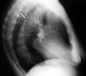 Radiografía lateral de tórax, donde se aprecia un aumento del diámetro antero-posterior de la aorta. Fuente: elaboración propia.