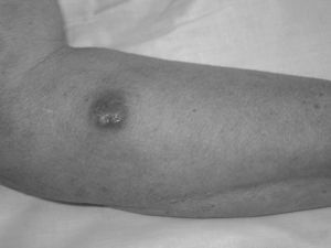 Lesión nodular eritematosa con periferia violácea de aproximadamente 1cm de diámetro en antebrazo derecho.
