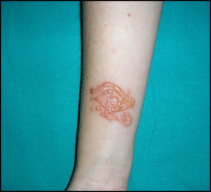 Lesión sobreelevada predominantemente de aspecto queloideo con algunas vesículas en el antebrazo derecho coincidiendo con el lugar de aplicación de la tinta del tatuaje temporal.