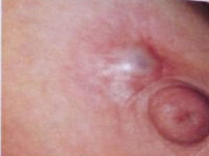 Fistulización periareolar recidivante de mama izquierda en la paciente. Se observa protrusión periareolar que corresponde a un absceso.
