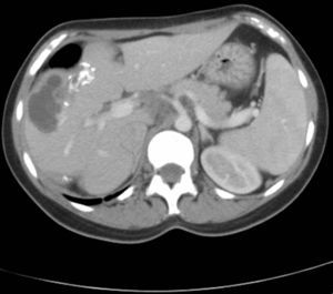 Quiste hidatídico complicado en corte de TC abdominal.