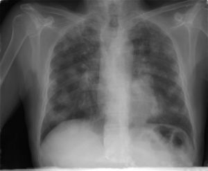 Radiografía simple de tórax: imagen de nódulos pulmonares múltiples en «suelta de globos». Fuente: elaboración propia.