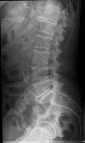 Radiografía simple de columna lumbar, perfil. Signos degenerativos. Fuente: elaboración propia a partir de historia clínica informatizada del paciente.