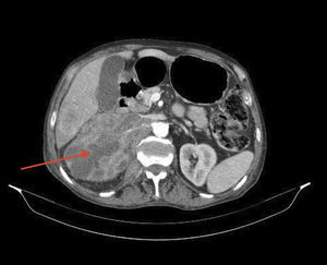Tomografía Axial Computerizada (TAC) toraco-abdominal. Gran tumoración retroperitoneal derecha (flecha). Fuente: elaboración propia.
