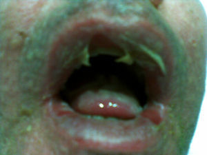 Lesiones ampollosas en mucosa oral.