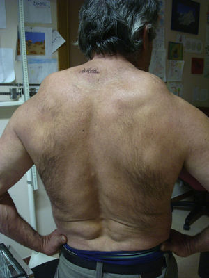Visión dorsal de paciente con enfermedad de Madelung. Fuente: Marta Garín Alegre.