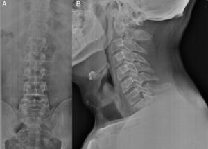 Radiografías zona lumbosacra (A) y cervical (B).
