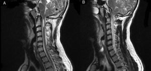Cortes de RM en los que se aprecia cavidad siringomiélica (A) y descenso de amígdalas cerebelosas (B).