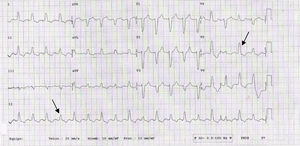 ECG. Ritmo sinusal básico con alternancia eléctrica (flechas) más visible en V4-5, bloqueo completo de rama izquierda.