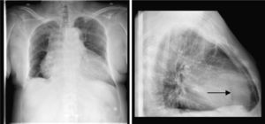 Radiografía de tórax. Cardiomegalia global con imagen «en garrafa». En proyección lateral, imagen de radiolucencia (flecha).