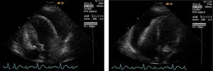 Ecocardiograma. Bamboleo (swinging) del corazón en el saco pericárdico que justifica en este caso la AE.