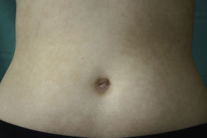 Máculas hipopigmentadas, no descamativas, confluentes, distribuidas simétricamente en el abdomen.
