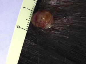 Granuloma piógeno en gestante de 28 semanas.