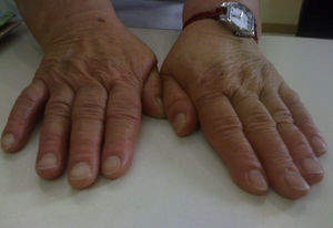 Edema con fóvea bilateral en manos y dolor selectivo sobre MCF 1.a y 5.a MCF de la mano izquierda.