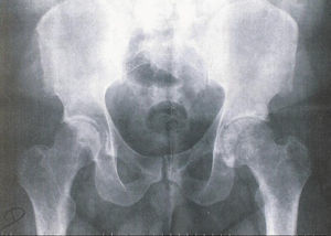 Radiografía abdominal.