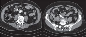 TAC toraco-abdominal donde puede apreciarse la afectación aórtica y la interrupción del aporte de contraste a ambas ilíacas. Caso uno. Elaboración propia.