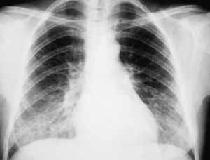 Radiografia de tórax con patrón alveolointersticial bilateral.