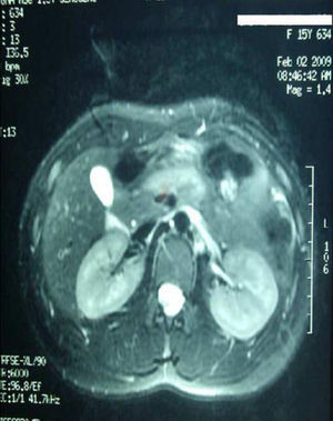 Resonancia magnética de vías biliares y páncreas.