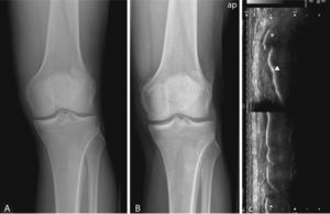 A) Radiografía anteroposterior de la rodilla izquierda, inmediatamente tras el traumatismo. No se observan alteraciones radiológicas en el aspecto medial de la rodilla. De forma casual se encuentra una rótula tripartita, con los fragmentos en el ángulo superoexterno de la misma. B) Radiografía anteroposterior 2 meses después de la inicial, apreciándose una calcificación adyacente al epicóndilo medial, tipo I de Mendes (1). C) Ecografía, incidencia longitudinal sobre epicóndilo femoral, se aprecia la calcificación (*) y la cortical del fémur. Existe continuidad en la porción superior con la cortical femoral, no demuestra continuidad de la calcificación con la cortical en la zona más distal. En la imagen inferior, se puede apreciar la integridad del LCI y la porción más externa del menisco interno.