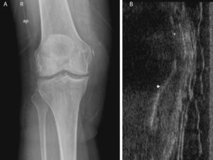 A) Radiografía anteroposterior de la rodilla derecha, 7 semanas tras el traumatismo. Calcificación adyacente al epicóndilo medial, tipo II de Mendes (1). Se aprecia también imágenes lineales algo más densas que continúan inferiormente el LCI. Cambios degenerativos en compartimento femorotibial interno. B) Ecografía en un corte longitudinal, sobre el LCI, calcificación (*), localización algo más distal que en el caso anterior, línea hiperecogénica correspondiente a la cortical del epicóndilo femoral, separada de la imagen lineal cálcica (→). No se demuestra continuidad de la calcificación con la cortical ni superior ni inferior. El LCI aparece heterogéneo, zonas hiperecogénicas e hipoecoicas, sobre todo en su porción más profunda, adyacente a la cortical, y ligeramente separado del cóndilo femoral, en relación con proceso cicatricial.
