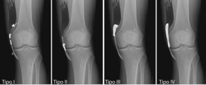 Esquema radiológico que representa las diferentes localizaciones y apariencias del síndrome de PS, modificado de Medes et al. La flecha corresponde al músculo-tendón del aductor mayor, el asterisco (*) a la calcificación y la cabeza de flecha al LCI. Tipo I: beak-like apariencia, con orientación inferior y anclaje femoral. Tipo II: drop-like apariencia, orientación inferior y paralela al fémur. Tipo III: apariencia elongada con orientación superior y paralela al fémur. Tipo IV: beak-like apariencia, con orientación superior e inferior y anclaje femoral.