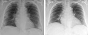 Evolución de las lesiones pulmonares. En la radiografía de tórax inicial se evidencian 3 focos condensativos y alteraciones en los hilios. En la radiografía final (tras 6 meses de tratamiento con corticoides), se observa la desaparición de las lesiones.