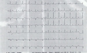 Electrocardiograma donde se presenta ritmo sinusal 78 lpm, PR 0,8 segundos, onda delta en DI y de V2 a V6, Q en DIII y aVF, T negativa en aVR y aVL.