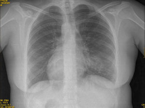 Radiografía de tórax donde se muestra dextrocardia e imágenes compatibles con bronquiectasias en la base del hemitórax izquierdo.