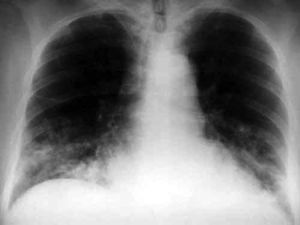 Radiografía posteroanterior y lateral de tórax en la que se observan condensaciones en ambas bases pulmonares.