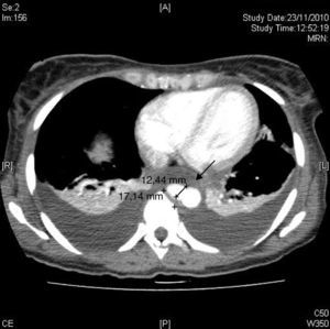 Pseudoaneurisma de la aorta torácica descendente, retrocardiaca, de aproximadamente 2 centímetros.