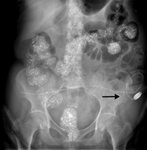 Radiografía de abdomen en la que se visualiza un catéter de diálisis peritoneal bien posicionado (flecha).