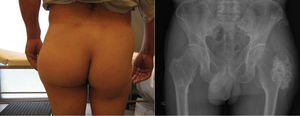 (elaboración propia). Deformidad de cadera y proyección antero-posterior de pelvis con encondroma femoral izquierdo gigante y múltiples encondromas en fémur derecho y crestas ilíacas.