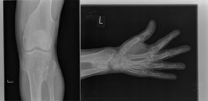 (elaboración propia). Osteocondromas en radio, fémur y extremo proximal de peroné.