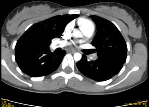 TEP masivo bilateral con trombo a caballo de la bifurcación de ambas arterias pulmonares principales.