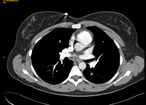 TEP bilateral con posible infarto periférico en língula y pequeño derrame pleural izquierdo.