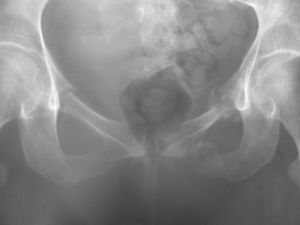 Radiografía en la que se aprecia línea de fractura en fase de consolidación de las ramas ilio e isquiopubiana izquierda sin desplazamiento.