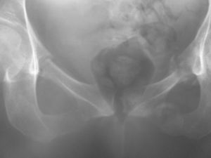Radiografía donde se aprecia una nueva fractura contralateral de las ramas ilio e isquipubiana.