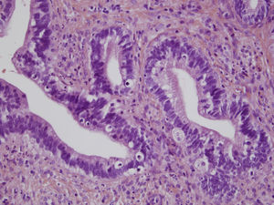 En la imagen anatomopatológica en hematoxilina-eosina, se observan mitosis explosivas.