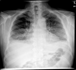 Radiografía anteroposterior de tórax. Derrame pleural bilateral, con engrosamiento de cisuras y líneas A y B de Kerley. Hallazgos compatibles con ICC.