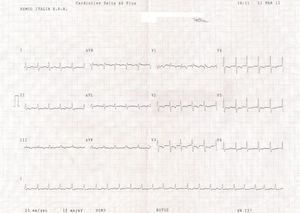 Electrocardiograma de control a las 48 horas de seguimiento. El bigeminismo había desaparecido. La frecuencia ventricular había aumentado a 137 latidos por minuto. El ritmo de base era nodal. Persistían las ondas T negativas en las derivaciones precordiales V2-V3-V4-V5 anteriormente descritas y el mismo bloqueo de rama derecha incipiente.