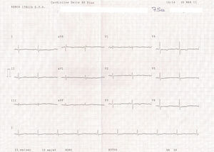 Electrocardiograma de control a los 20 días de seguimiento. Mostraba un ritmo sinusal a 56 latidos ventriculares por minuto, una onda P pulmonar, unas ondas T negativas en las derivaciones precordiales V3-V4 y el mismo bloqueo de rama derecha incipiente.