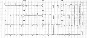 Ritmo sinusal a 70 lat./min. Eje −39° (ligera desviación a la izquierda). Hipertrofia ventricular izquierda. Elaboración propia.