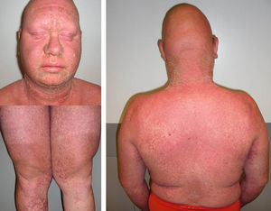 Dermatitis exfoliativa que evoluciona en dirección craneocaudal hasta alcanzar un estado eritrodérmico, acompañado de edema facial. Se observa en el paciente alopecia areata universal, asociada al síndrome pluriglandular autoinmune tipo ii.