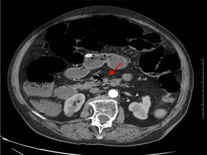 Defecto de repleción en arteria mesentérica superior compatible con trombo (flecha roja), a unos 5cm de la salida de la aorta.