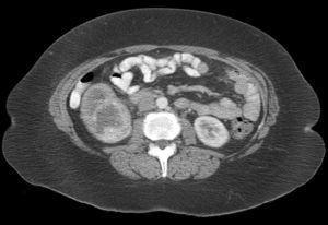 TAC abdomen.