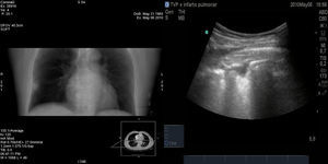 Radiología simple de infarto pulmonar y ecografía típica del infarto pulmonar con típica imagen de lesión hipoecogénica de morfología triangular con base periférica.