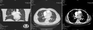 Imágenes de TAC del infarto pulmonar en las que se aprecia defecto de repleción en arteria subsegmentaria de lóbulo medio, de localización central, con área de condensación de morfología triangular con base pleural típica del infarto pulmonar.
